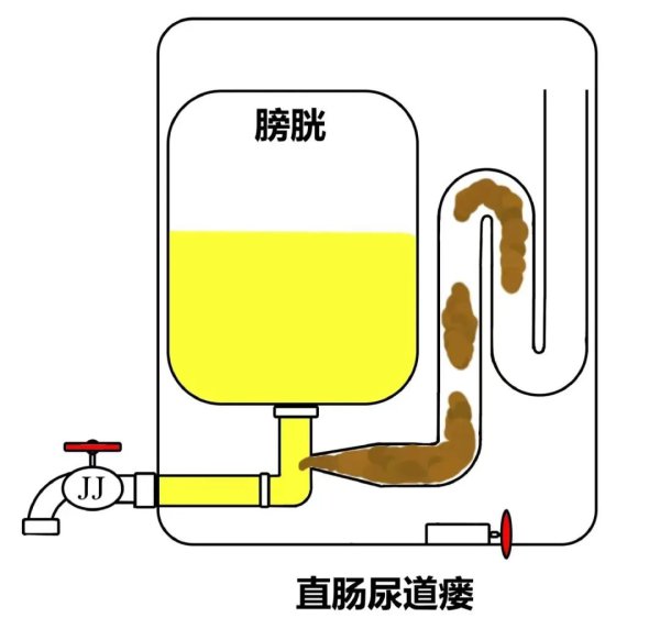 男童用小鸡鸡排便5年！医师恐慌：拖这样晚才就医！有患儿家长提纲振领辛酸
